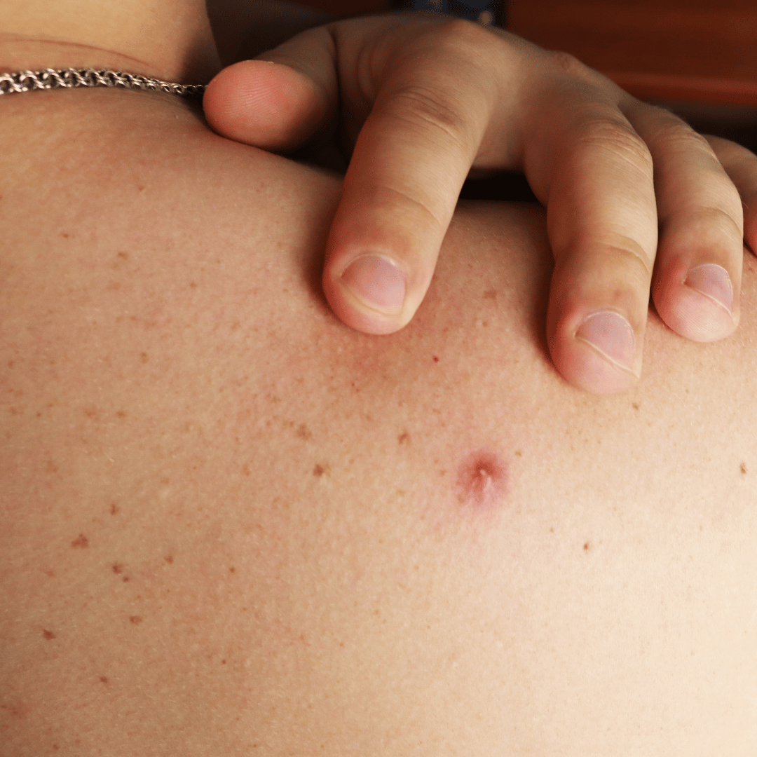 Mann mit Pickel am Rücken