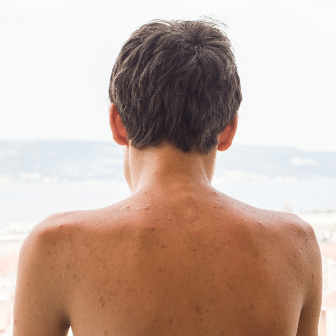6 Tipps für Männer, um Pickel und Akne am Rücken loszuwerden - MR HANDSOME
